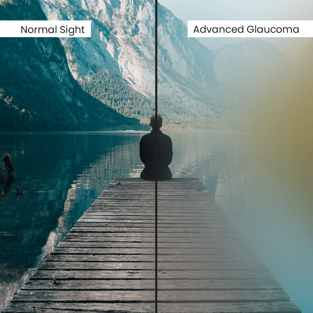 Understanding Glaucoma